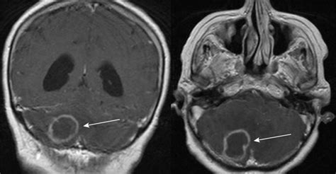 loss of muscle coordination results from damage to the|Cerebellum Brain Damage: Causes, Effects, and Rehabilitation .